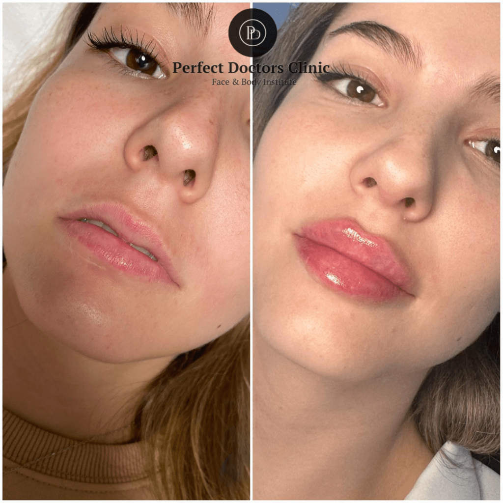 How the Best Doctors in dubai Use Juvederm for Non-Surgical Lip Augmentation Juvederm