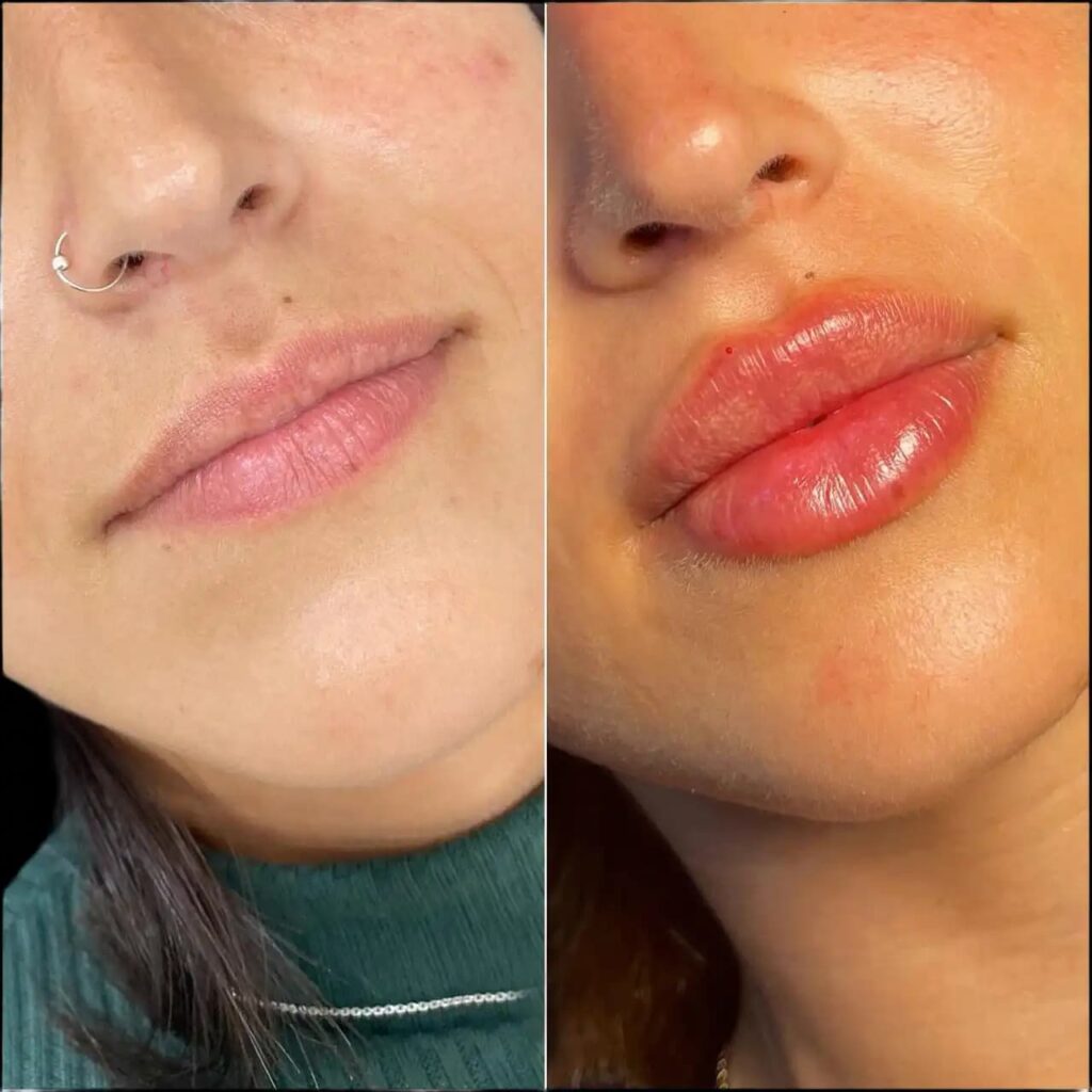 Dubai’s Hidden Gems for Lip Fillers: Best Doctors