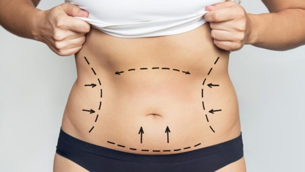 Recovering from Full Body Liposuction in Dubai Your Journey Explained Liposuction in Dubai